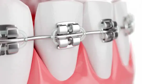 self ligating dental braces