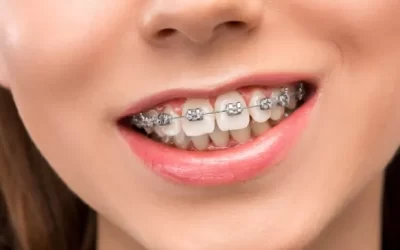 Understanding Malocclusion: Common Bite Problems and Their Solutions