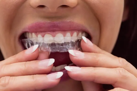 invisalign clear aligners on teeth