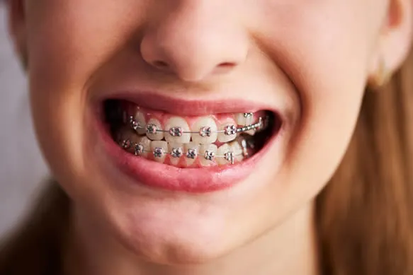 young girl smiling with metal dental braces
