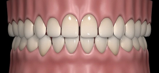 3D realistic rendering of teeth spacing